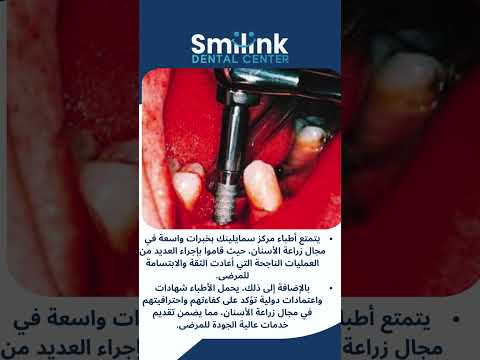 كم تكلفة زراعة الاسنان في مصر