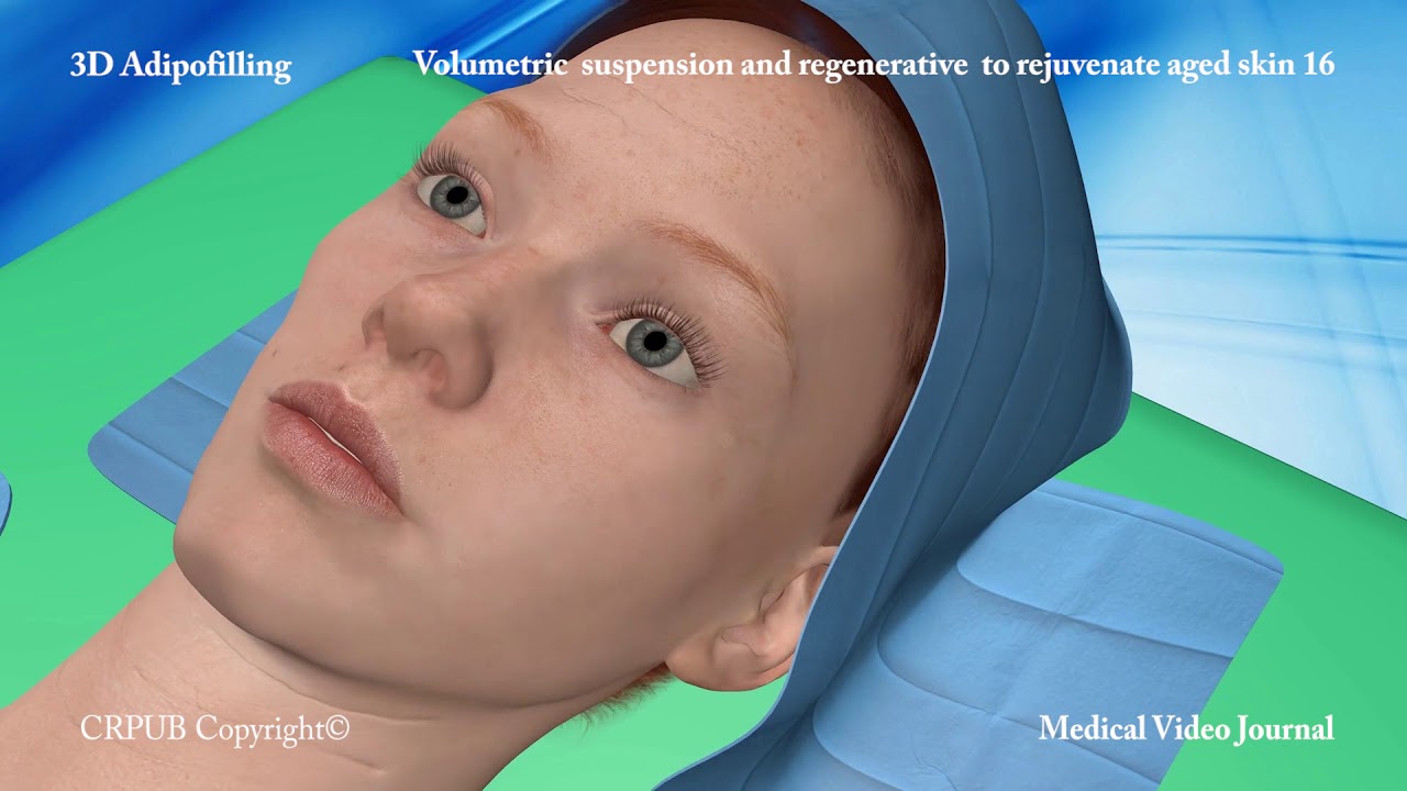 3D Adipofilling - New lipofilling technique