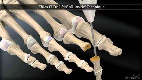 TrimIt Drill Pin Technique