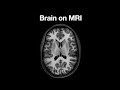 Anatomy of the Brain on MRI