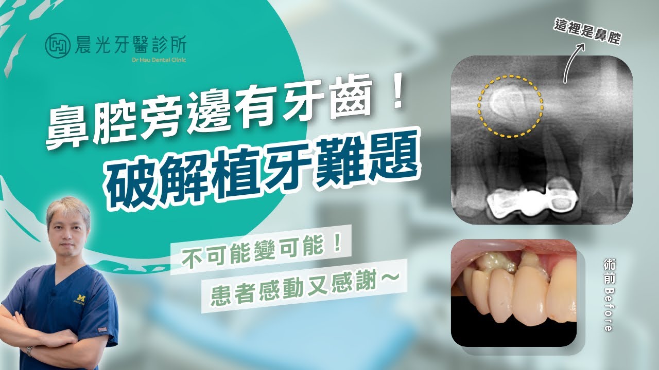 晨光案例|別人都說「一定要拔牙」? 縮圖