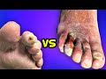 Emergency Vs Non-Emergency Toe Ulcer With Debridement!