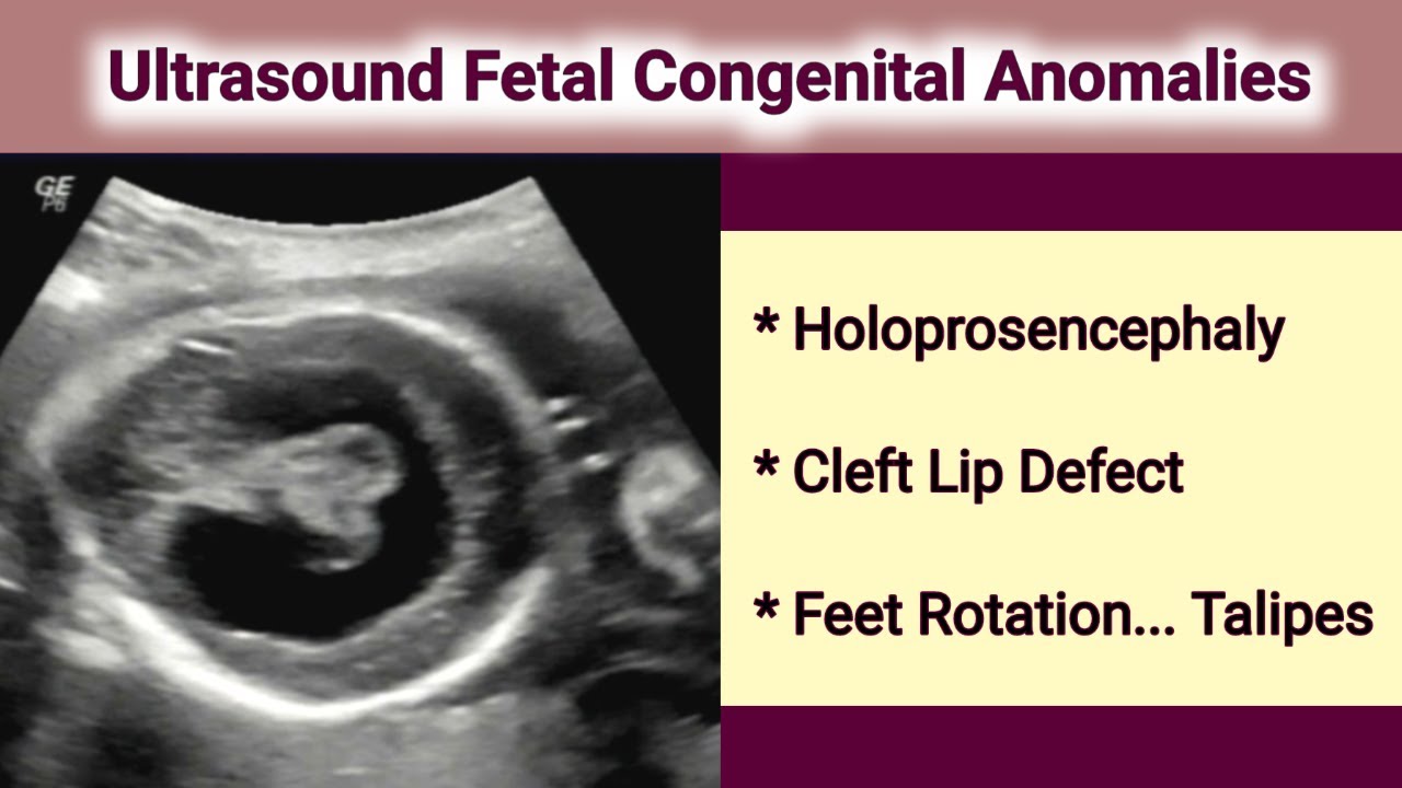 Ultrasound Fetal Holoprosencephaly