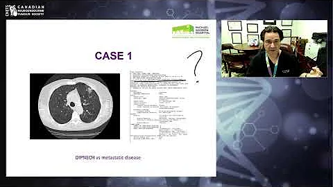 Surgery for Lung NETs - Dr. Carmine Simone (Thoracic Surgeon)