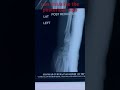 both bone forearm fracture treated conservatively