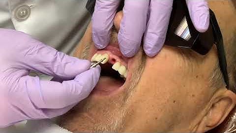 Penguin RFA - ISQ Implant Stability GoldenDent. Compare to Osstell ISQ.