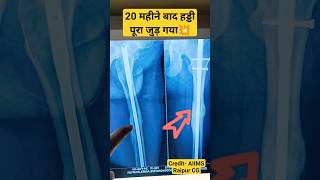 Broken Femur United After 20 Month 🔥 जांघ की हड्डी जुड़ी #femur #fracturerecovery #fracture #bone