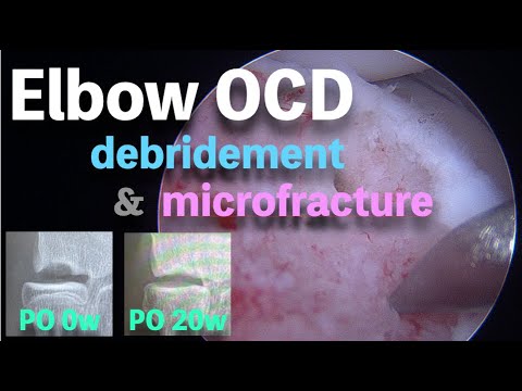 野球肘に対する鏡視下手術   Elbow OCD: Arthroscopic Debridement, Micro Fracture and Osteochondral Defect Recovery