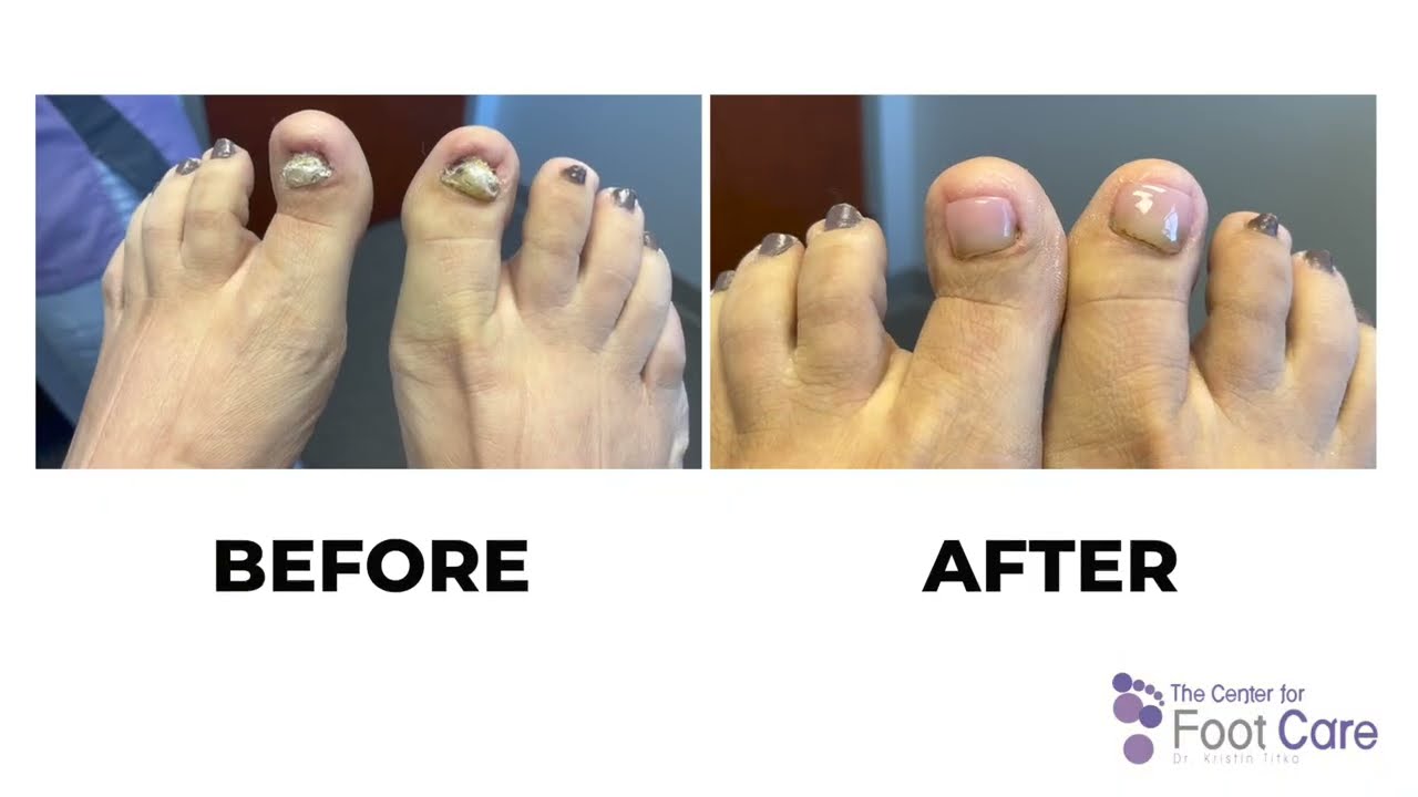 Keryflex Toenail Restoration by The Center for Foot Care - YouTube