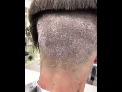 Как победить перхоть?! - YouTube