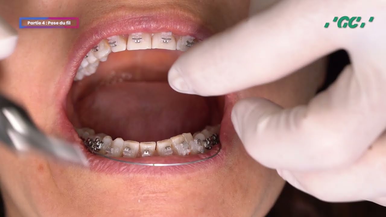 Vestibular bonding of self-ligating brackets EXPERIENCE ceramic