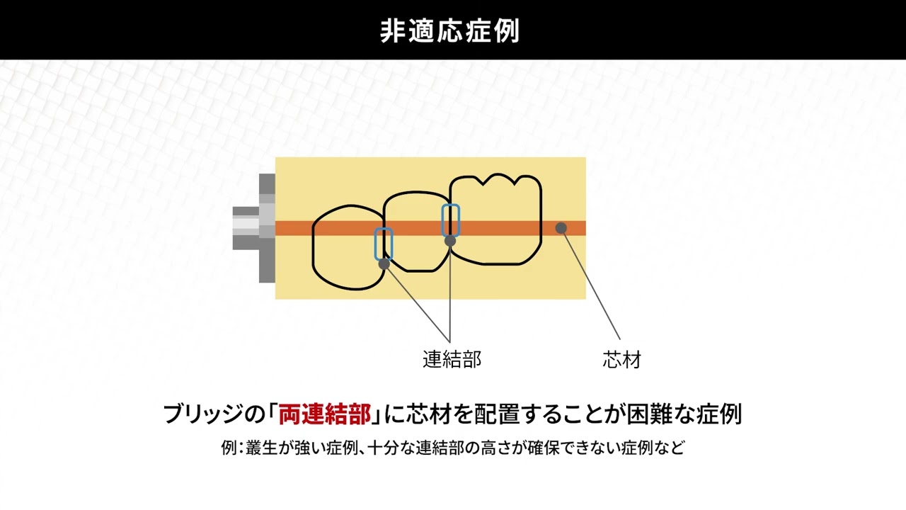アナトミカル白齒咬合形成法　歯科　歯科技工　レア シンボーQ&A】使用方法について① | Y-News