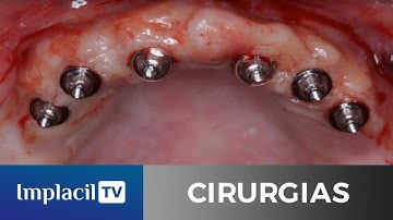 Cirurgia guiada com protocolo em carga imediata, por Lucas Massaru, Márcio Casati e Edson Matumoto