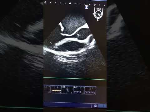 Very severe mitral