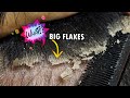 Dandruff Removal With Comb Big Flakes!!! Dandruff Scratching Satisfying #297