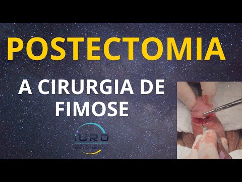 Vídeo: Restauração De Prepúcio: é Possível Com Ou Sem Cirurgia?