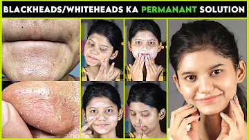 Remove BLACKHEADS WHITEHEADS CLOGED PORES Naturally | Permanent Results | Get Smooth Glowing Skin |