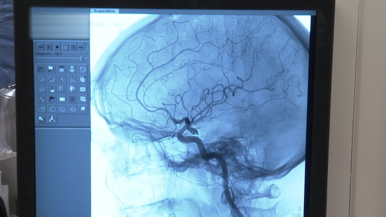 AVC : une équipe interventionnelle de pointe à l’hôpital Pasteur de Nice