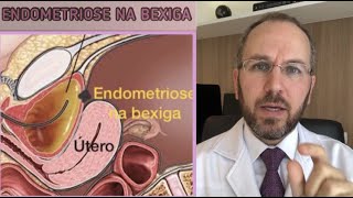 ENDOMETRIOSE NA BEXIGA