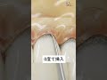【SRPが終わった後、歯肉に傷が入っています。何が問題ですか?(キュレットの操作方法)】今更聞けない歯科知識 新人歯科衛生士さんのためのお悩み相談室/萬田久美子先生 #shorts