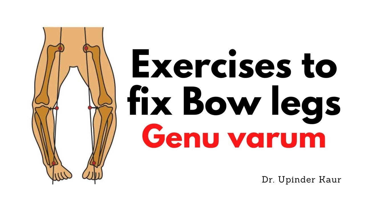 11 Easy Genu Varum Exercises for Bow Leg Correction