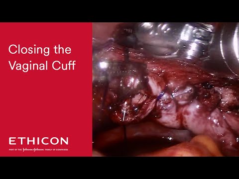 Robotic Lap Hysterectomy Close Vaginal Cuff - Stratafix | ETHICON