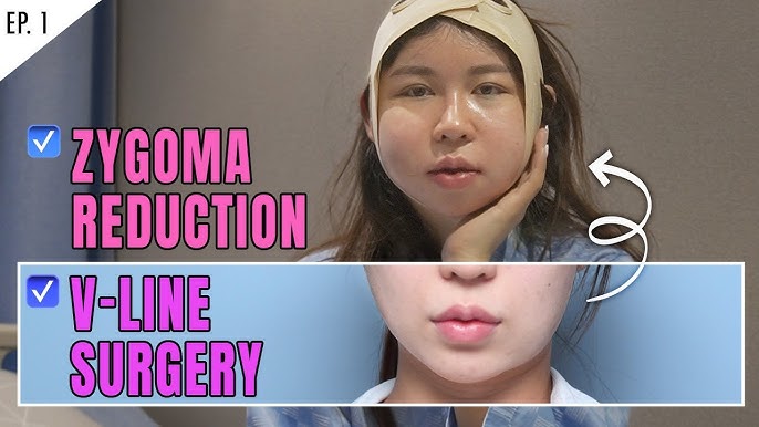 Facial Contouring Surgery Korea: 3D Cheekbone, Face Sculpting - The Line  Clinic