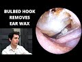 Bulbed Hook Used to Remove Soft Ear Wax