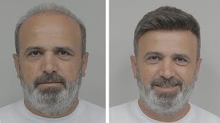 PROTEZ SAÇ NASIL YAPILIR - Hair Replacement