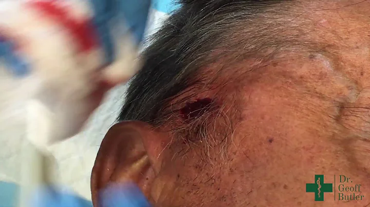 Superficial Removal of a Squamous Cell Cancer on t...