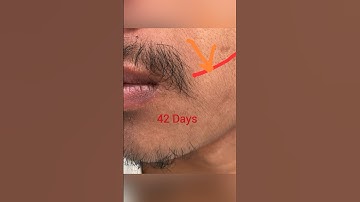 Minoxidil Beard Growth first 47 days Result #minoxidil #beardgrowth