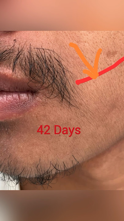 Minoxidil Beard Growth first 47 days Result #minoxidil #beardgrowth