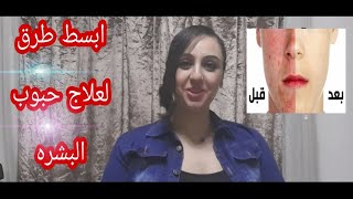 لو مش عايزه يتطلعلك حبوب تاني ابدا?