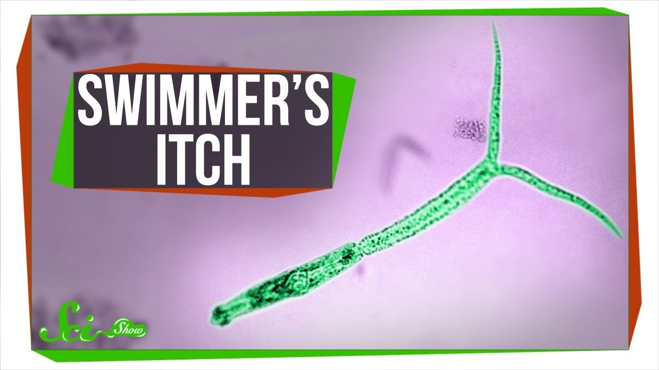Does Swimmer'S Itch Get Worse?
