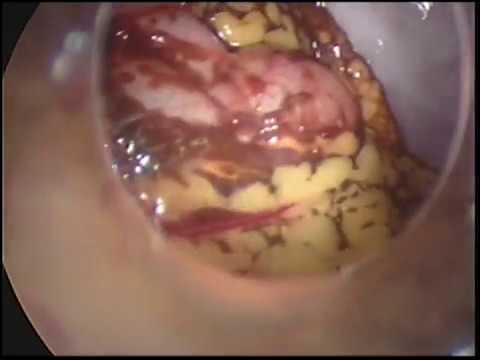 Video: Endometriosis Peritoneum Pelvis - Gejala, Rawatan Dan Sebabnya