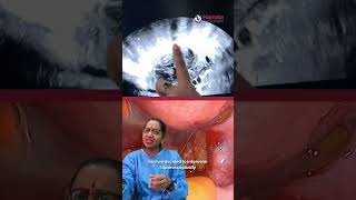 Silent Ectopic Pregnancy Case: When Observation Is Not Enough!| Mamata Fertility Hospital: Hyderabad