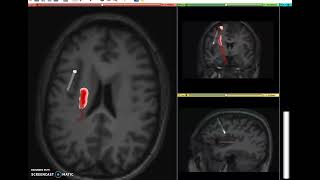 Intraoperative Uncertainty Visualization in Fiber Tracking