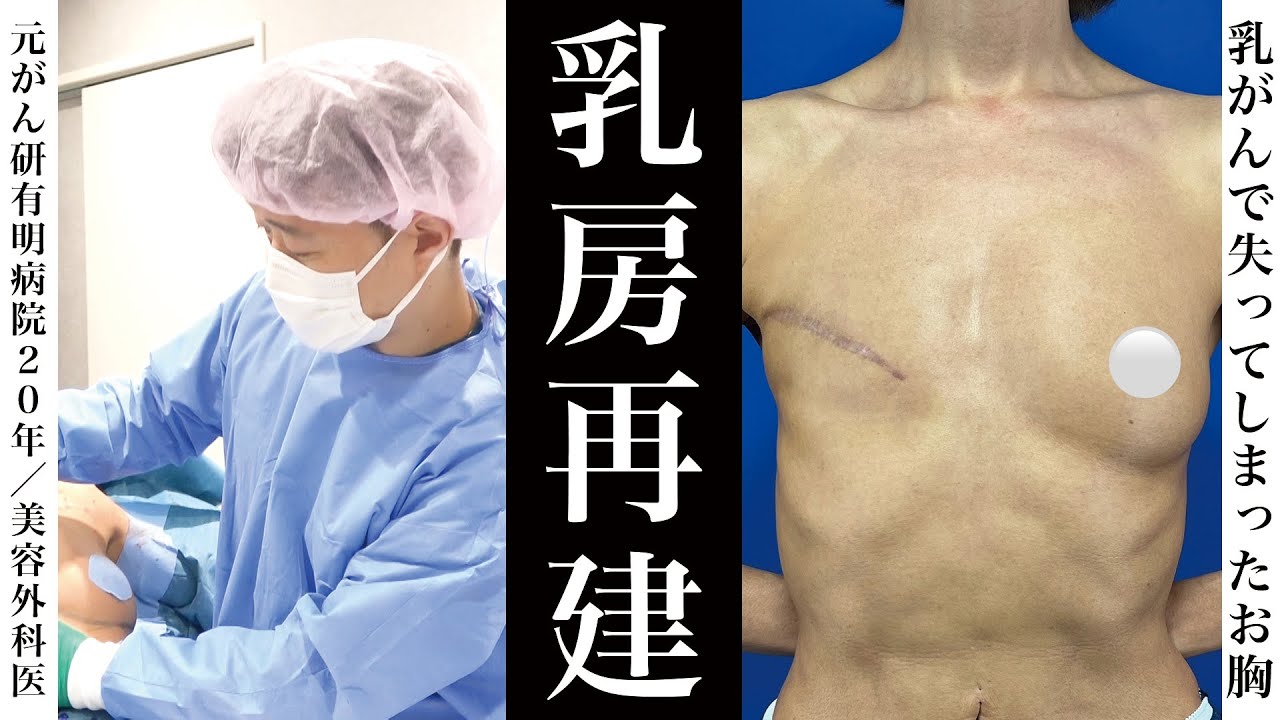 失ったお胸を取り戻す”乳房再建”。医者歴20年の経験と技術で解説。
