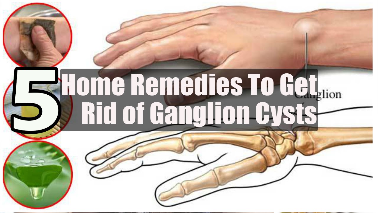 5 Home Remedies To Get Rid Of Ganglion Cysts By Top 5 Youtube