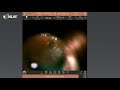 Intuitive Iridotomy Treatment with the Navilas® 577s Retina Laser