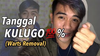 Tanggal KULUGO (warts) || 100% EFFECTIVE👍 Tanggal KULUGO (warts) || 100% EFFECTIVE👍