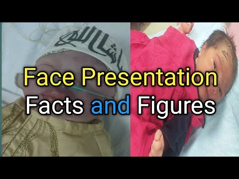 born face presentation