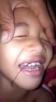 Cara alami Cabut Gigi pakai Benang