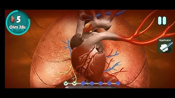 Ascending Aortic Aneurysm Surgery //Dr Najid  #heartsurgery