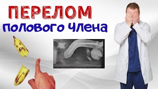 ПЕРЕЛОМ ПОЛОВОГО ЧЛЕНА / КАК СЛОМАТЬ ПОЛОВОЙ ЧЛЕН?