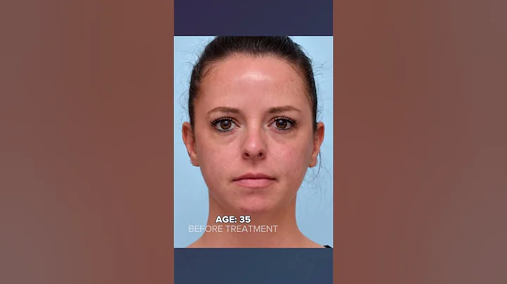 What Happens to Fillers Over Time? - DayDayNews