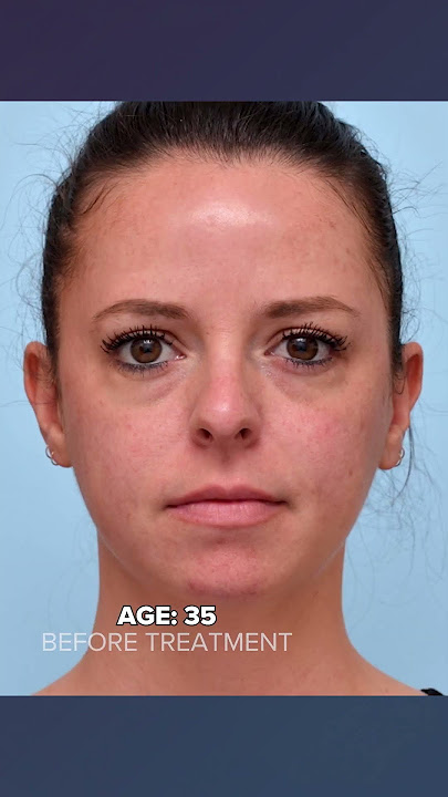 What Happens to Fillers Over Time?