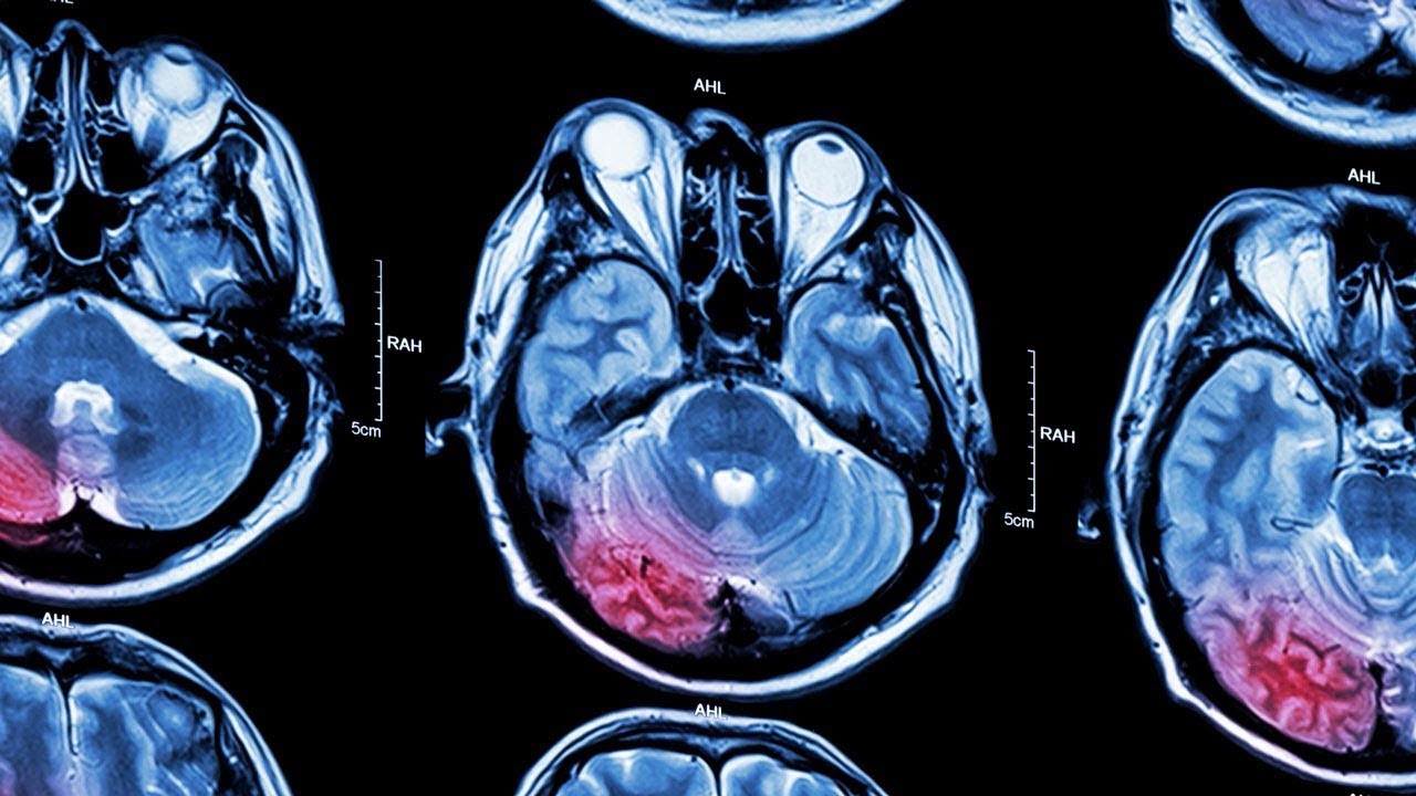 Stroke Awareness & Prevention: How to prevent stroke