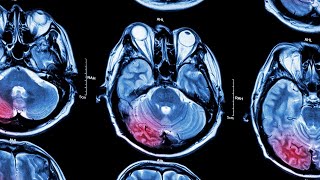 Stroke Awareness & Prevention: How to prevent stroke