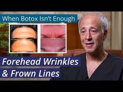 Treating Forehead Wrinkles [ How to get rid of #Stubborn #ForeheadLines when #Botox isn't Enough]